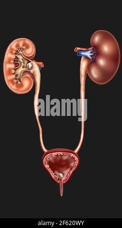 Calculs rénaux Banque D'Images