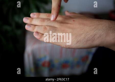 salvador, bahia / brésil - 11 avril 2019 : l'homme montre des parties du corps infectées par des symptômes du syndrome des mains et des pieds et de la bouche, connu sous le nom de Roseola. *** Loc Banque D'Images