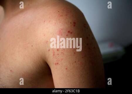 salvador, bahia / brésil - 11 avril 2019 : l'homme montre des parties du corps infectées par des symptômes du syndrome des mains et des pieds et de la bouche, connu sous le nom de Roseola. *** Loc Banque D'Images