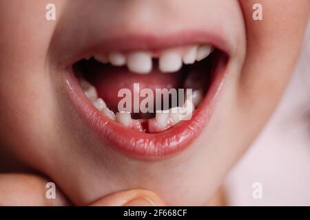 fermez la nouvelle plaie avec du sang dans la partie inférieure de la gencive de la première dent de bébé tombée Banque D'Images