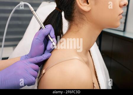 Femme ayant l'enlèvement de mole dans le centre médical utilisant laser sans contact. Élimination indolore des grains de beauté et des papillomes sur la peau humaine Banque D'Images