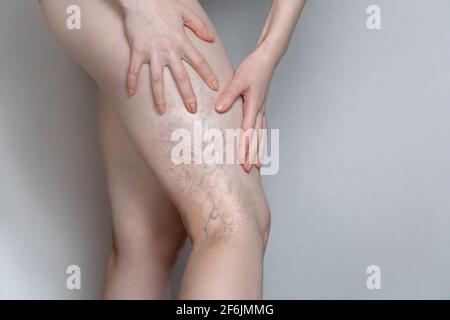 Femme montre une jambe avec des varices. Le concept de la santé humaine et de la maladie. Arrière-plan gris. Banque D'Images