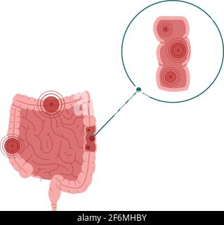 Illustration du vecteur de la maladie inflammatoire de l'intestin isolée sur fond blanc Illustration de Vecteur