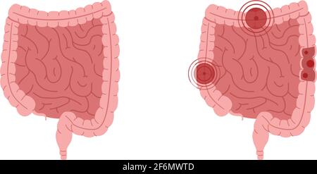 Illustration vectorielle plate d'intestins sains et d'intestins avec maladies inflammatoires. Illustration de Vecteur