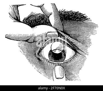 Chirurgie de la cataracte. Illustration du 19e siècle. Allemagne. Arrière-plan blanc. Banque D'Images
