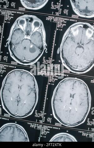 Imagerie par résonance magnétique, IRM, tomodensitométrie, imagerie radiologique. Tête avec cerveau en coupe transversale latérale Banque D'Images