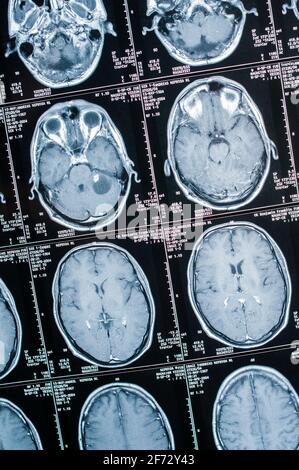 Imagerie par résonance magnétique, IRM, tomodensitométrie, imagerie radiologique. Tête avec cerveau en coupe transversale latérale Banque D'Images