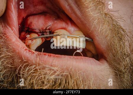 Photo frontale d'une personne avec des points de suture dans la bouche à la place de la dent manquante. Gencives dentaires avec des points de suture après l'installation d'un hea fermé Banque D'Images