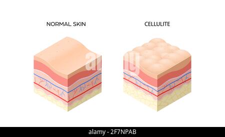 peau avec cellulite et peau normale coupe transversale de la peau humaine couches structure soins de la peau concept médical plat horizontal Illustration de Vecteur