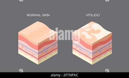 section transversale du vitiligo et de la peau normale de la structure des couches de la peau humaine soins de la peau concept médical plat horizontal Illustration de Vecteur