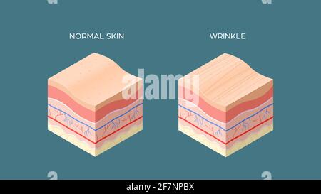 coupe croisée de peau normale et froissée de la structure des couches de peau humaine soins de la peau concept médical plat horizontal Illustration de Vecteur