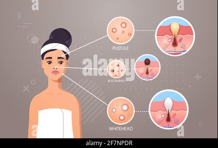 différents types de peau faciale acné pustule tête noire boutons de tête blanche sur le visage de la femme pores comedones cosmétologie problèmes de soin de la peau concept plat Illustration de Vecteur