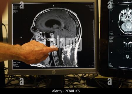 Médecin pointant vers l'IRM du cerveau humain sur l'écran de l'ordinateur Banque D'Images