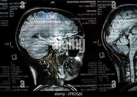 Imagerie par résonance magnétique du cerveau en gros plan. IRM Banque D'Images