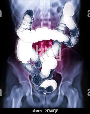 Foyer sélectif de l'image de l'enema de baryum ou de l'image radiographique de gros intestin isolé sur l'abdomen flou dos-rayons x montrant anatomique de deux points pour Banque D'Images