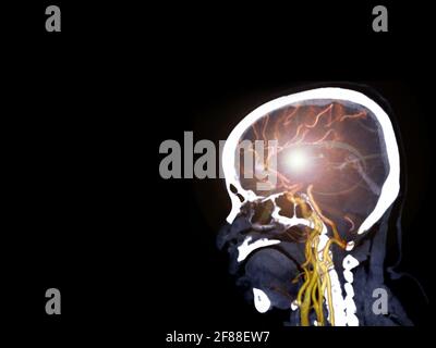 TDM cerveau ou TDM angiographie du cerveau fusion 2D et 3D rendu de l'image . concept de technologie médicale. Banque D'Images