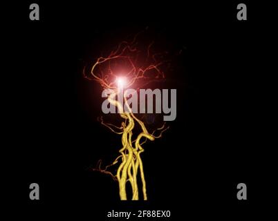 Angiographie TDM CÉRÉBRALE ou TDM cérébrale image 3D de rendu montrant l'artère cérébrale. Banque D'Images