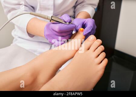 Traitement infection fongique sur le crapaule de la femme avec le podologue utilisant un laser médical. Infection fongique sur les ongles du pied humain Banque D'Images