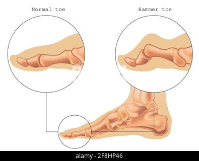 L'illustration médicale montre la différence entre un orteil normal et un orteil marteau, avec des annotations. Illustration de Vecteur