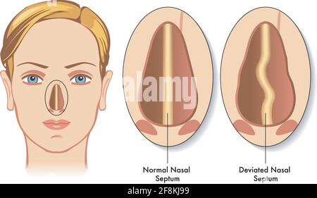 L'illustration médicale montre la comparaison entre un septum nasal normal et un septum nasal dévié, avec des annotations. Illustration de Vecteur