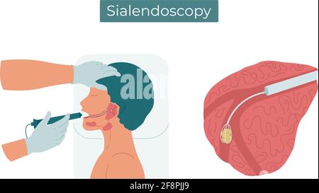 Illustration vectorielle plate de la sialendoscopie. Chirurgie pour enlever une pierre du conduit de la glande salivaire parotide. Illustration de Vecteur