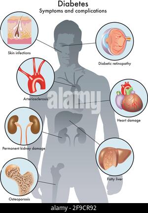 Illustration médicale des symptômes et complications du diabète. Illustration de Vecteur