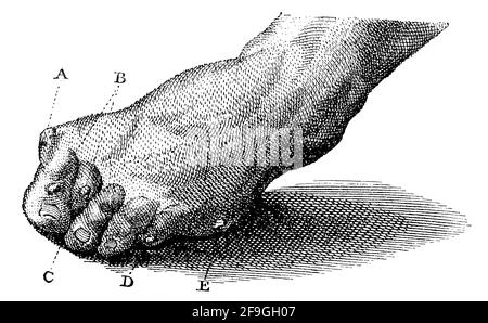 Cornes (A) et callosités (B, C, D, E). Illustration du 19e siècle. Allemagne. Arrière-plan blanc. Banque D'Images