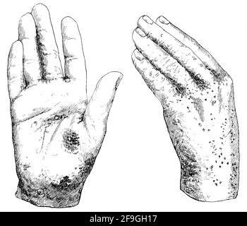 Mains affligées de gale. Illustration du 19e siècle. Allemagne. Arrière-plan blanc. Banque D'Images