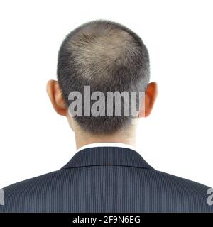 Symptôme d'amincissement des cheveux sur une tête d'homme - signe de perte de cheveux Banque D'Images