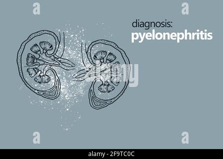 Pyélonéphrite, aninflammation du rein, généralement due à une infection bactérienne. Modèle de style minimaliste avec orgue à main Banque D'Images