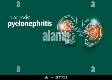 Pyélonéphrite, aninflammation du rein, généralement due à une infection bactérienne. Modèle de style minimaliste avec orgue à main Banque D'Images