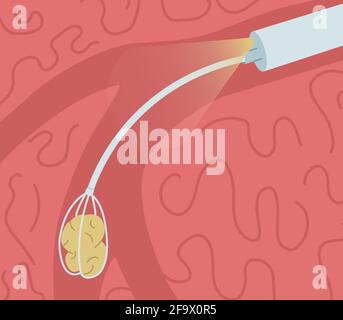 Retrait d'une pierre du conduit de la glande salivaire. Illustration du vecteur de sialendoscopie. Illustration de Vecteur