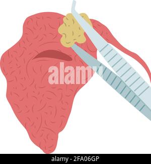 Illustration vectorielle du retrait d'une pierre de la glande salivaire parotide. Sialolithiase Illustration de Vecteur