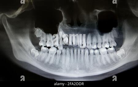 Radiographie dentaire avec bretelles. Orthopantomographie, OPG X-ray DR numérique pour les dents de l'adolescence Banque D'Images
