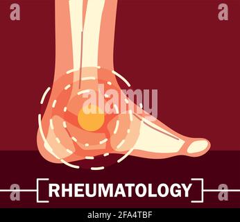 rheumatologie os de cheville Illustration de Vecteur