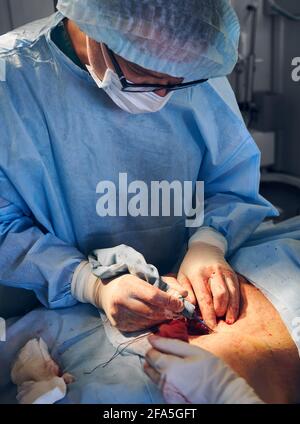 Chirurgien plastique mâle en gants stériles faisant une abdominoplastie ou une opération chirurgicale plastique. Médecin éliminant l'excès de graisse de l'abdomen du patient. Concept de médecine et chirurgie plastique abdominale. Banque D'Images