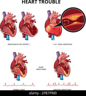 Infographies de vecteur de maladie cardiaque. Illustration d'informations graphiques médicales sur le cœur humain Illustration de Vecteur