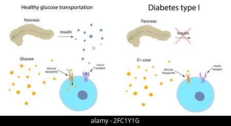 Diabète de type 1 et métabolisme sain du glucose, illustration Banque D'Images