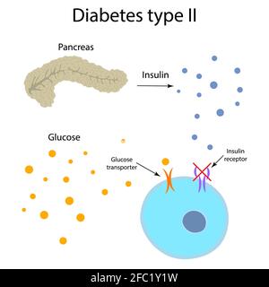Diabète de type 2, illustration Banque D'Images