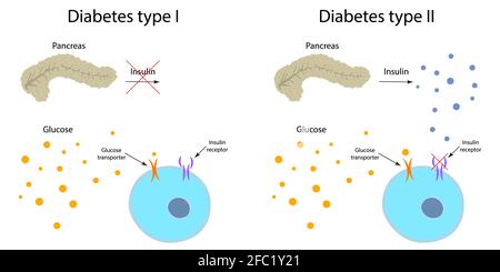 Diabète de type 1 et 2, illustration Banque D'Images