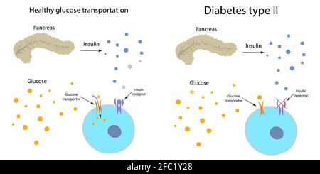 Diabète de type 2 et métabolisme sain du glucose, illustration Banque D'Images