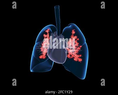 Infection pulmonaire virale, illustration Banque D'Images