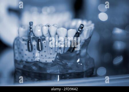 Modèle transparent de dents humaines avec implants en gros plan. Banque D'Images