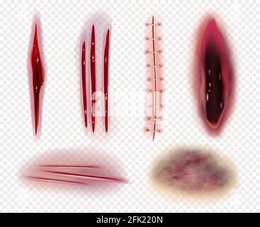 Cicatrices réalistes. Coupures plaies ecchymoses ecchymoses sang coutures vecteur collection de modèles Illustration de Vecteur