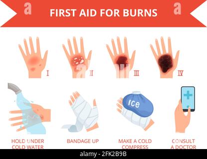 Brûler la peau. Premier traitement feu de main humaine ou destruction chimique blessure graviera sécurité de la peau pour les personnes infographics vecteur Illustration de Vecteur