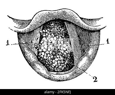 A ventre plat sur le larynx. Cordes vocales et villi polyp. Illustration du 19e siècle. Allemagne. Arrière-plan blanc. Banque D'Images