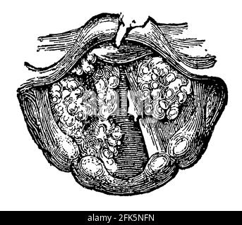 Ulcère dans le larynx. Illustration du 19e siècle. Allemagne. Arrière-plan blanc. Banque D'Images