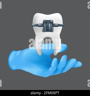 Main de dentiste portant un gant chirurgical bleu tenant un modèle en céramique de la dent avec un renfort en métal. illustration 3d réaliste d'un plan orthodontique Illustration de Vecteur