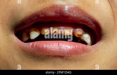 Les Soins Dentaires A La Clinique Dentaire Dent Cariee Pourri Close Up Macro Traitement Des Canaux D Endodontie Photo Stock Alamy