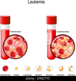 Leucémie. Globules rouges et blancs dans le tube à essai. Comparaison et différence entre le sang sain et les cancers du sang. Gros plan des érythrocytes, monocytes Illustration de Vecteur